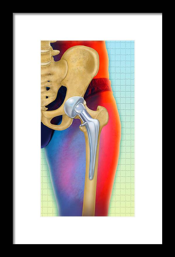 Art Framed Print featuring the photograph Prosthetic Hip Replacement by Chris Bjornberg