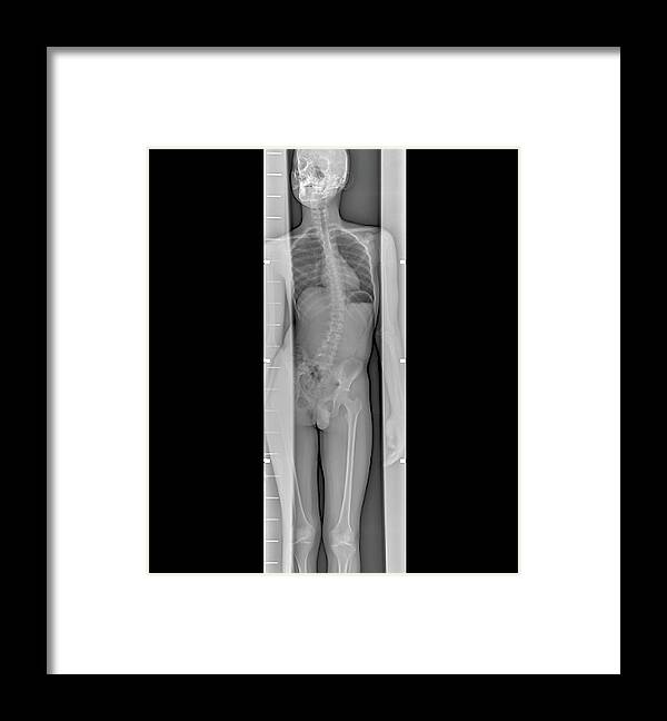 Whole Body Framed Print featuring the photograph Scoliosis Of The Spine #1 by Zephyr/science Photo Library