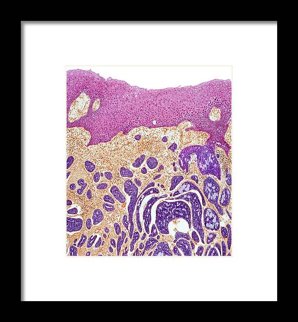 Adenoid Cystic Carcinoma Framed Print featuring the photograph Tongue Cancer #1 by Steve Gschmeissner