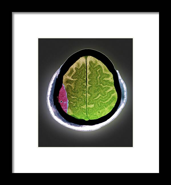 Human Framed Print featuring the photograph Brain Haemorrhage #11 by Zephyr