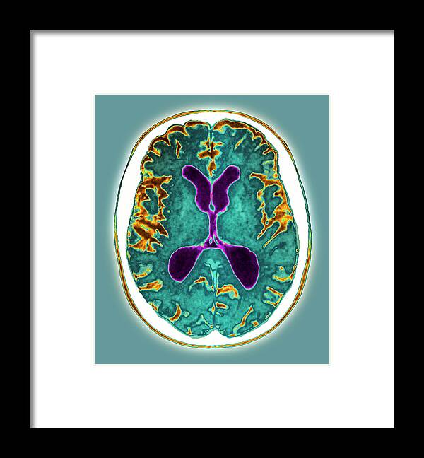 Alzheimer's Disease Framed Print featuring the photograph Alzheimer's Disease #3 by Zephyr/science Photo Library