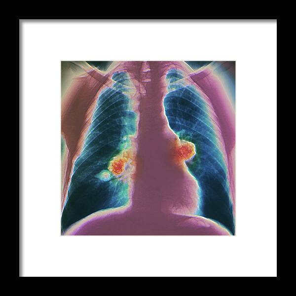 Colour Framed Print featuring the photograph Treatment Of Lung Aneurysms #3 by Zephyr/science Photo Library