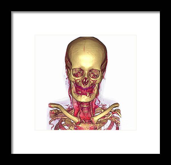 Angiography Framed Print featuring the photograph Male Skull & Arterial System #4 by Scott Camazine
