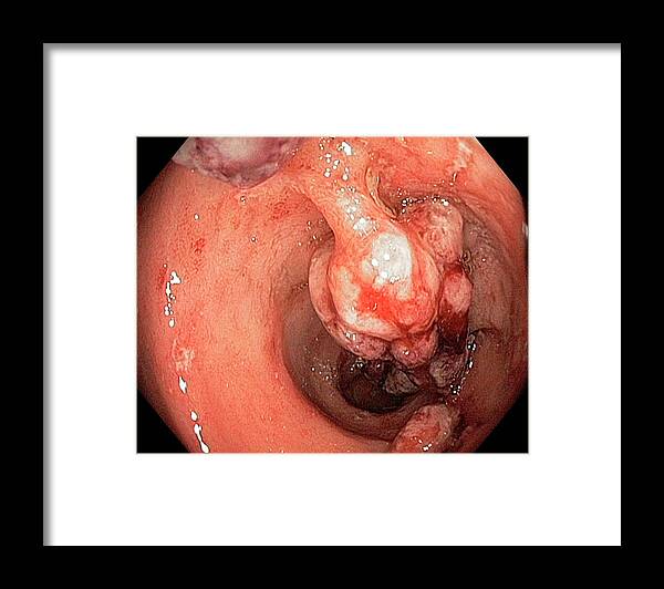 Abnormal Framed Print featuring the photograph Crohn's Disease #8 by Gastrolab