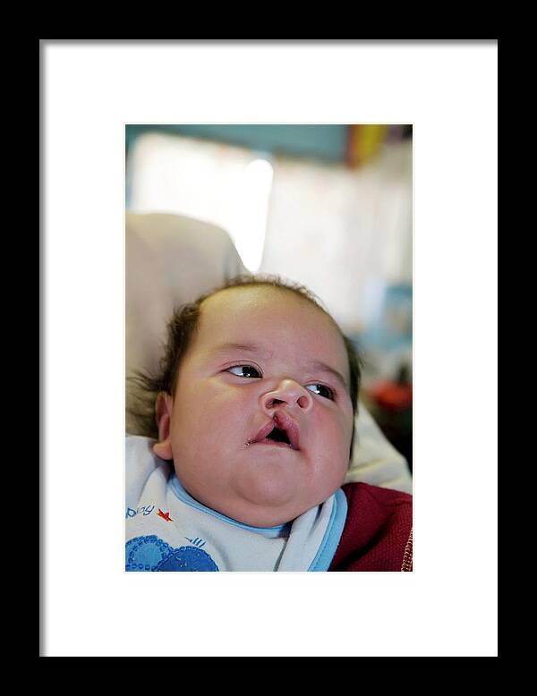 Human Framed Print featuring the photograph Baby With A Cleft Lip by Jim West