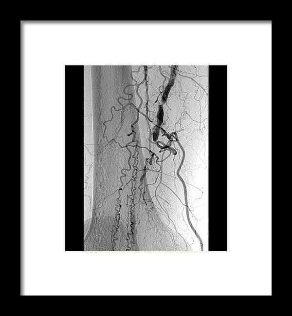 Diabetes Framed Print featuring the photograph Blocked Femoral Artery by Zephyr/science Photo Library
