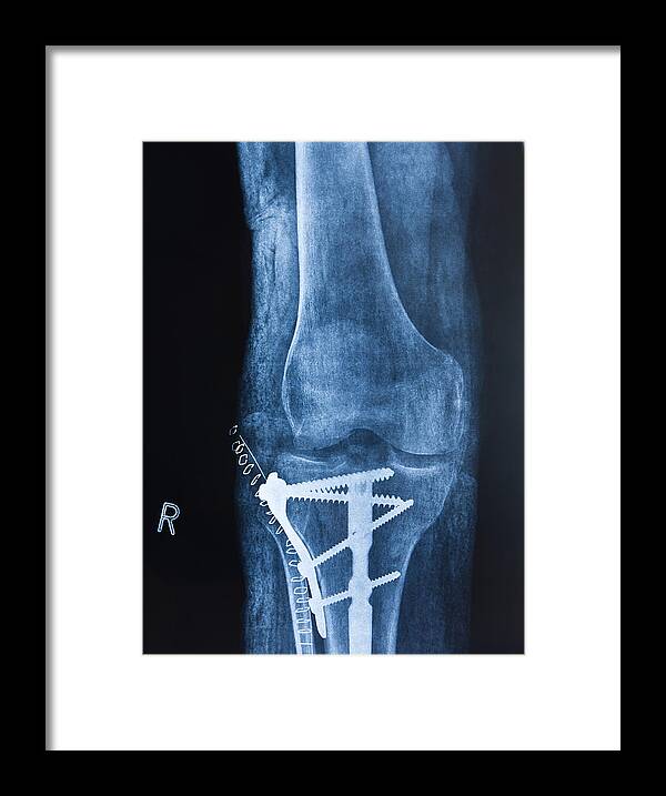 Broken Leg Framed Print featuring the photograph Broken leg by Pedre