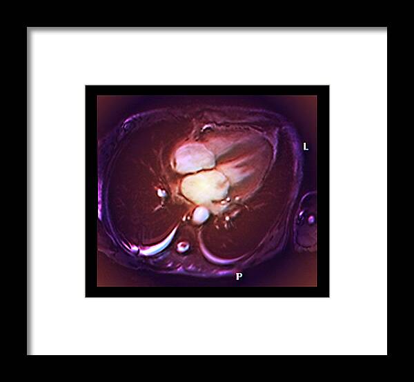 Hypertension Framed Print featuring the photograph Cardiac Mitral Valve Leak by Zephyr/science Photo Library