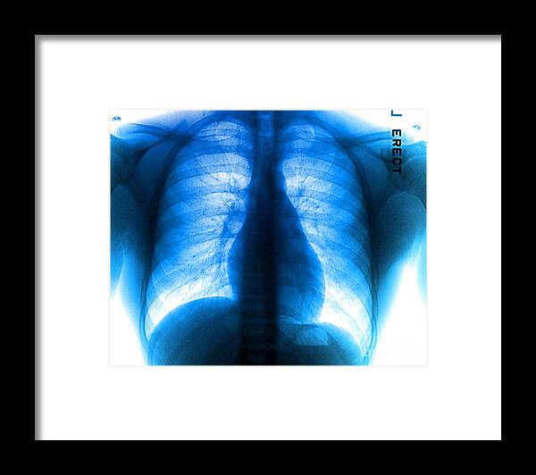 Medical Framed Print featuring the photograph Chest X-ray by Living Art Enterprises, LLC