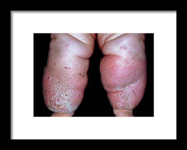 Elephantiasis Framed Print featuring the photograph Elephantiasis by Dr. R. Triller/science Photo Library