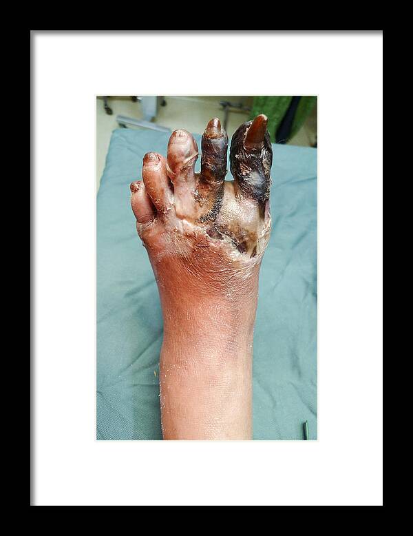 Unhygienic Framed Print featuring the photograph Foot gangrene by Karl Tapales