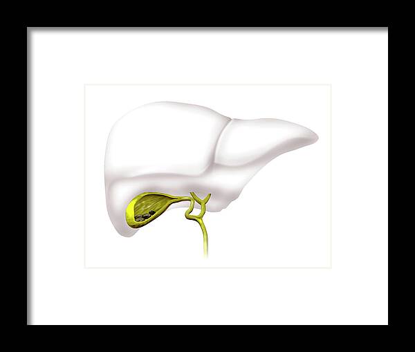3 Dimensional Framed Print featuring the photograph Gallstones by Harvinder Singh