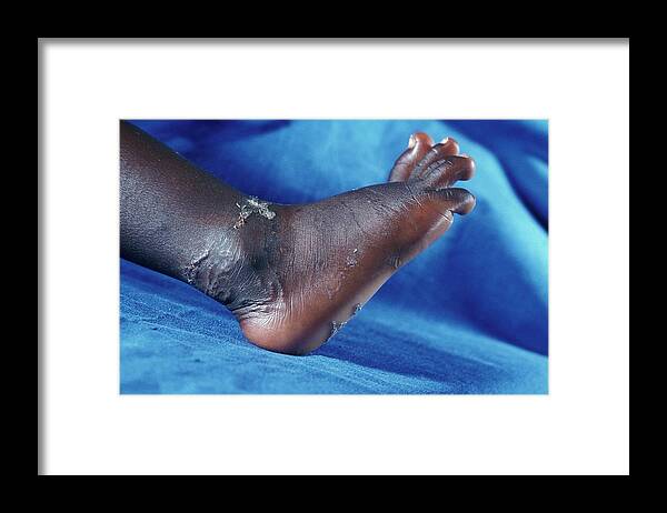 Dog Hookworm Framed Print featuring the photograph Hookworm Infection by Dr M.a. Ansary/science Photo Library