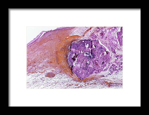 Light Micrograph Framed Print featuring the photograph Infective Endocarditis by Pr. D. Christol - Cnri
