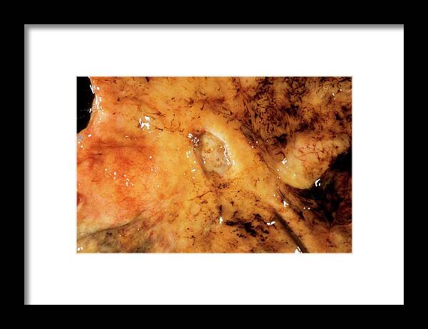 Nobody Framed Print featuring the photograph Intestinal Ulcer by Cnri