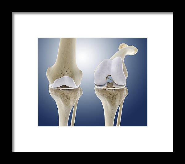 Knee Framed Print featuring the photograph Knee flexion anatomy, artwork by Science Photo Library