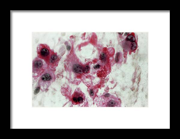 Light Micrograph Framed Print featuring the photograph Liposarcoma by Cnri