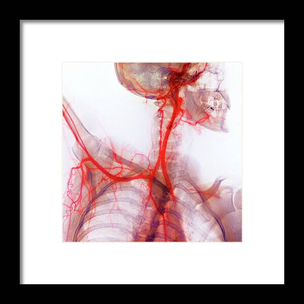 Subclavian Artery Framed Print featuring the photograph Neck And Shoulder Arteries by Cnri