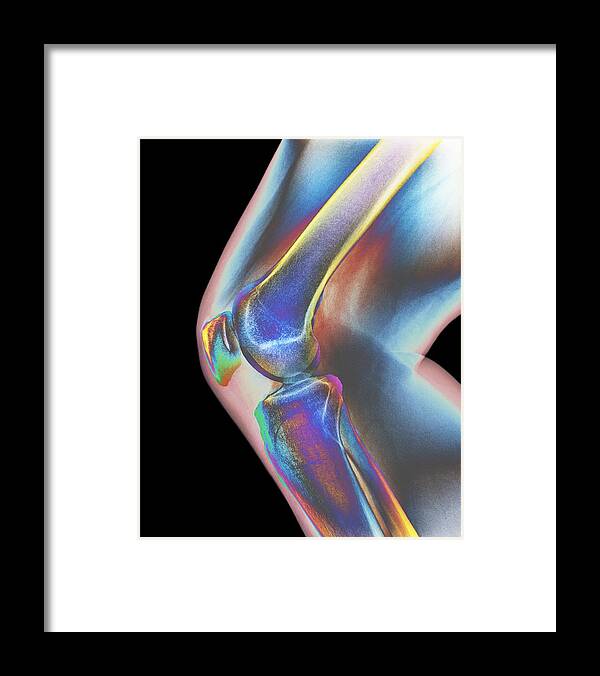 Anatomy Framed Print featuring the photograph Normal knee, X-ray by Dr P. Marazzi