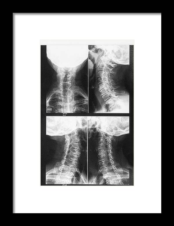 Xray Framed Print featuring the photograph Osteoarthritis Of The Neck by Brian Gadsby/science Photo Library