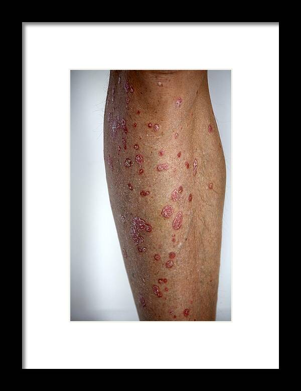Skin Framed Print featuring the photograph Psoriasis skin condition on man's leg by Andrew Holt