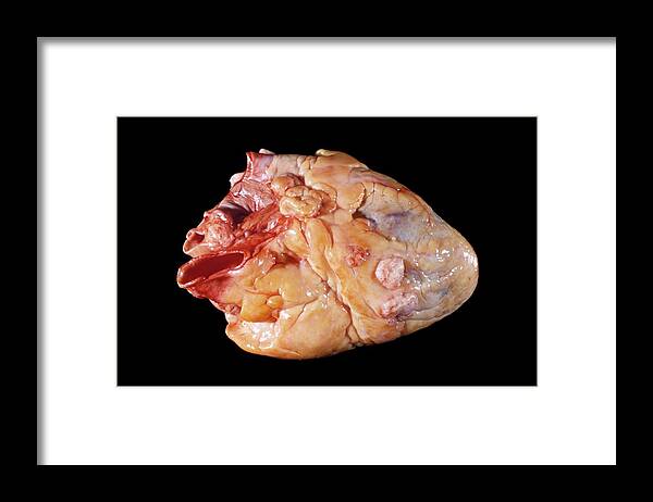 Still Life Framed Print featuring the photograph Secondary Heart Cancer by Pr. M. Forest - Cnri