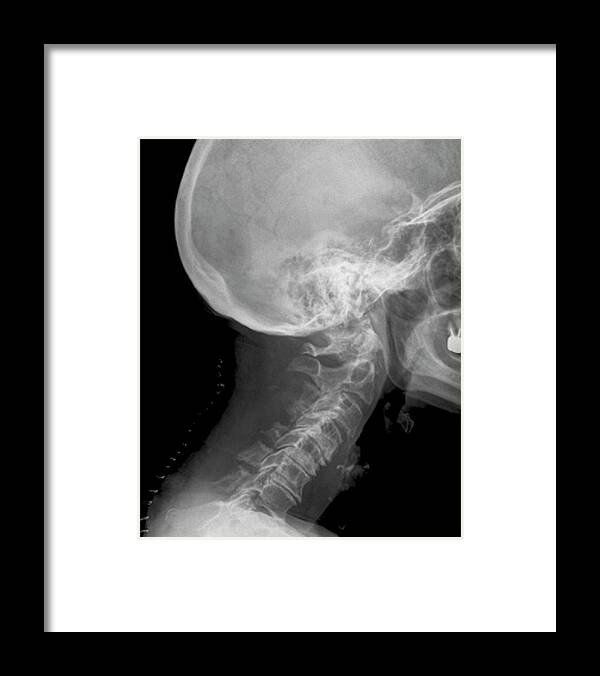 X-ray Framed Print featuring the photograph Spinal Surgery On The Neck by Zephyr/science Photo Library