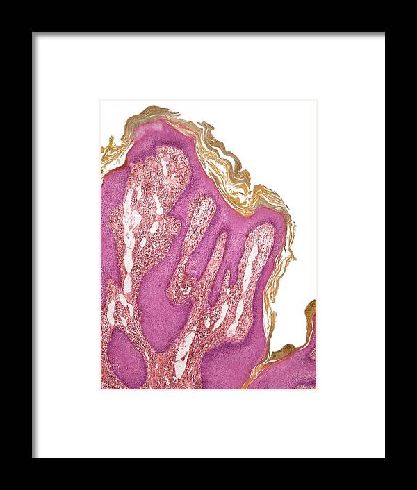 White Background Framed Print featuring the photograph Wart, light micrograph by Steve Gschmeissner/spl