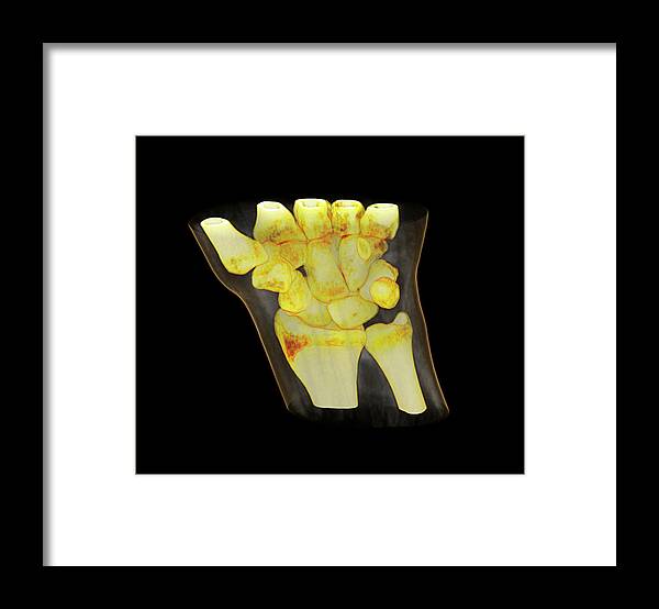 Wrist Framed Print featuring the photograph Wrist Bones by Antoine Rosset/science Photo Library