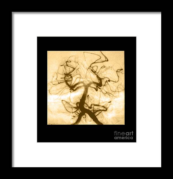 Abnormal Cerebral Angiogram Framed Print featuring the photograph Angiogram Of Embolus In Cerebral Artery #1 by Medical Body Scans