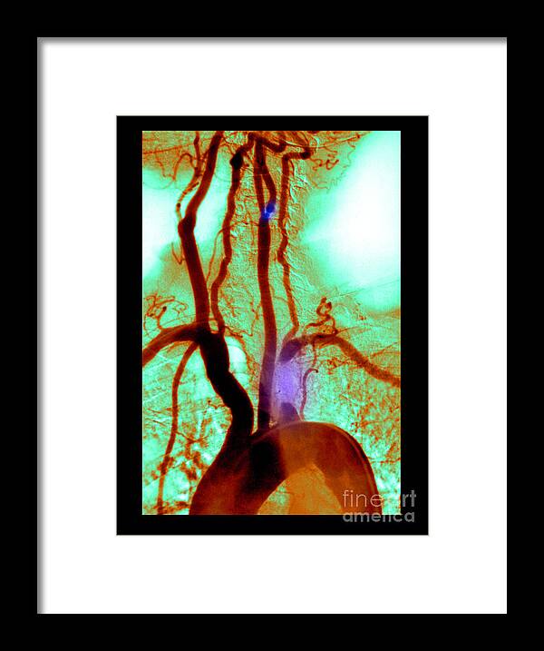 Abnormal Angiogram Framed Print featuring the photograph Aortic Arch Angiogram #1 by Medical Body Scans