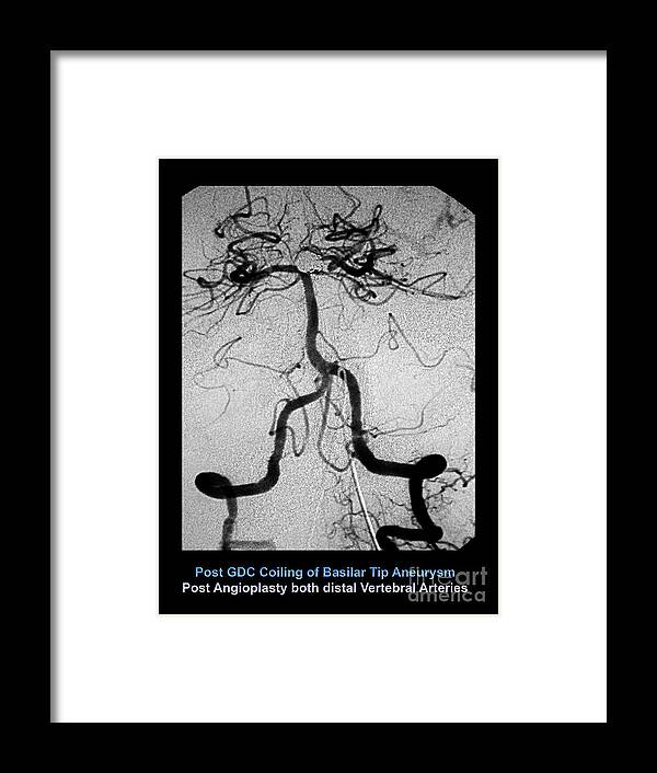 Cerebral Framed Print featuring the photograph Cerebral Angiogram by Medical Body Scans