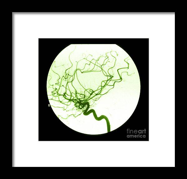 Cerebral Angiogram Framed Print featuring the photograph Internal Carotid Cerebral Angiogram #1 by Medical Body Scans
