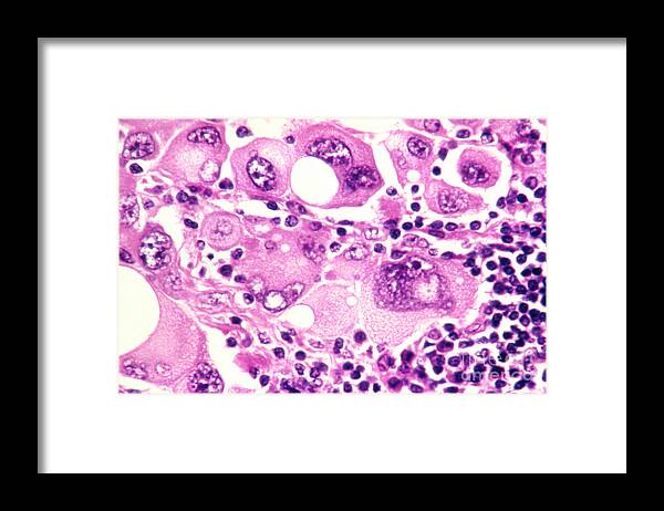 Melanoma Framed Print featuring the photograph Melanoma #1 by Science Source