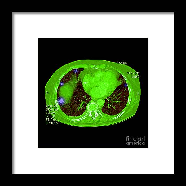 Abnormal Lung Ct Framed Print featuring the photograph Metastatic Cancer Of The Lungs #1 by Medical Body Scans