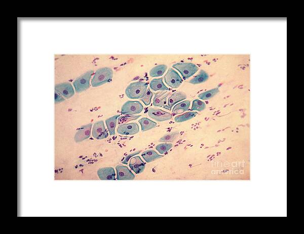 Medical Framed Print featuring the photograph Pap Smear Cancer #1 by Science Source