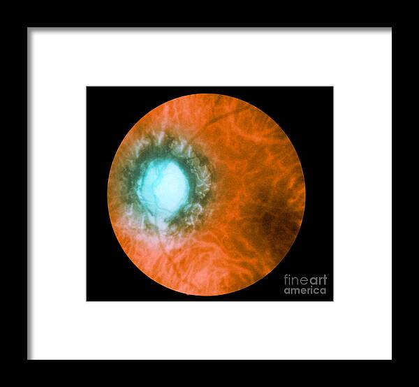 Bacteria Framed Print featuring the photograph Retina Infected By Syphilis #1 by Science Source