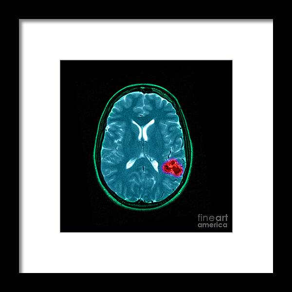 Abnormal Cerebral Blood Vessels Framed Print featuring the photograph Mri Of Brain Avm #10 by Medical Body Scans