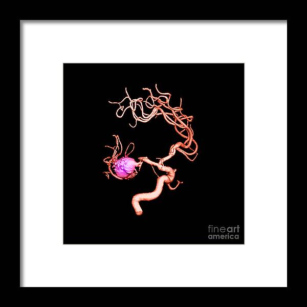 3-d Imagery Framed Print featuring the photograph Aneurysm In The Human Brain #2 by Medical Body Scans
