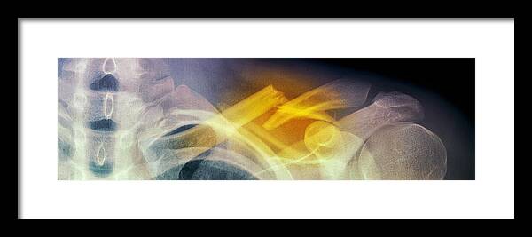 Bone Framed Print featuring the photograph Fractured Collar Bone, X-ray #2 by Du Cane Medical Imaging Ltd