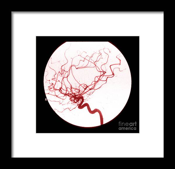 Cerebral Angiogram Framed Print featuring the photograph Internal Carotid Cerebral Angiogram #2 by Medical Body Scans
