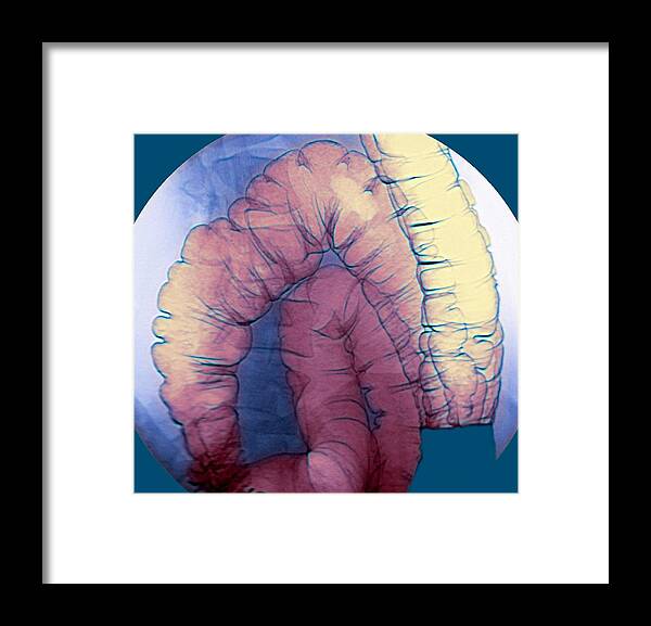 Coloured Framed Print featuring the photograph Large Intestine, X-ray #2 by Du Cane Medical Imaging Ltd