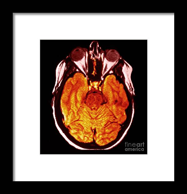 Brain Framed Print featuring the photograph Mri Of Normal Brain #39 by Science Source
