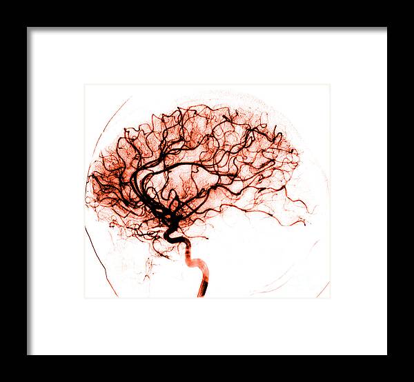 Catheter Cerebral Angiogram Framed Print featuring the photograph Cerebral Angiogram by Medical Body Scans