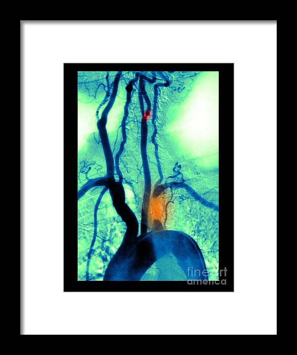 Abnormal Angiogram Framed Print featuring the photograph Aortic Arch Angiogram by Medical Body Scans