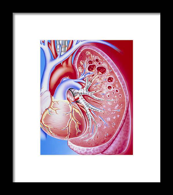 Tuberculosis Framed Print featuring the photograph Art Of Pulmonary Tuberculosis With Lung Cavities by John Bavosi