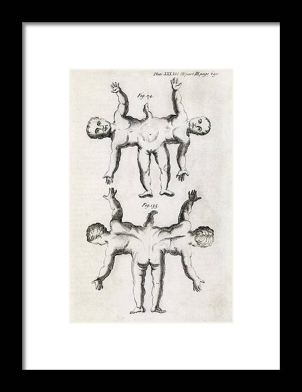 Conjoined Twins Framed Print featuring the photograph Conjoined Twins, 18th Century by Middle Temple Library