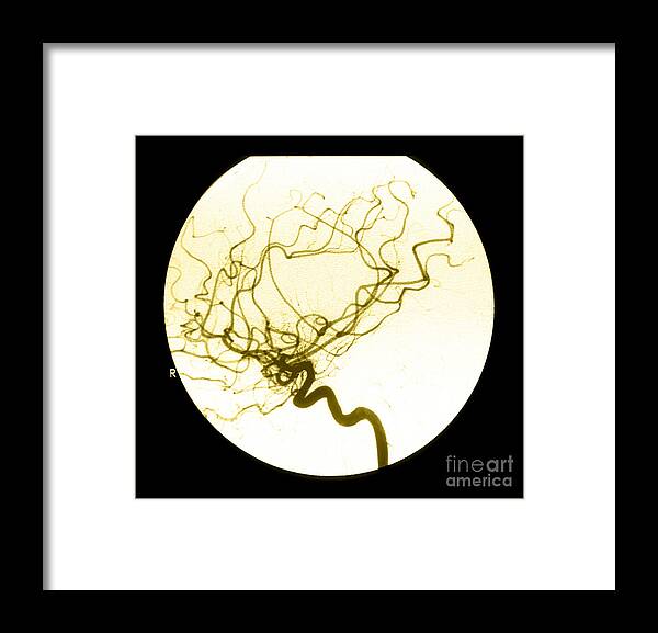 Cerebral Angiogram Framed Print featuring the photograph Internal Carotid Cerebral Angiogram by Medical Body Scans