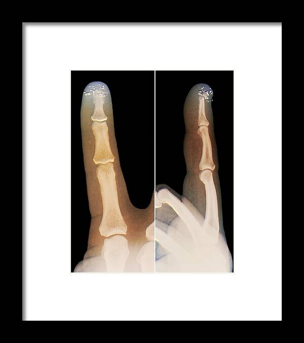 Coloured Framed Print featuring the photograph Metal Filings In The Finger, X-ray by Zephyr