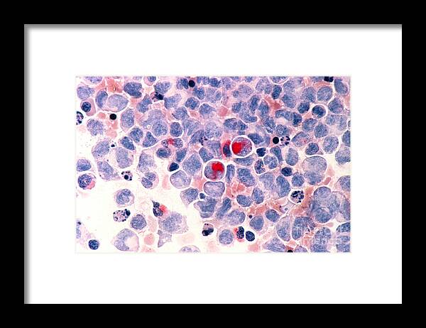 Myelocytic Leukemia Framed Print featuring the photograph Myelocytic Leukemia by Science Source
